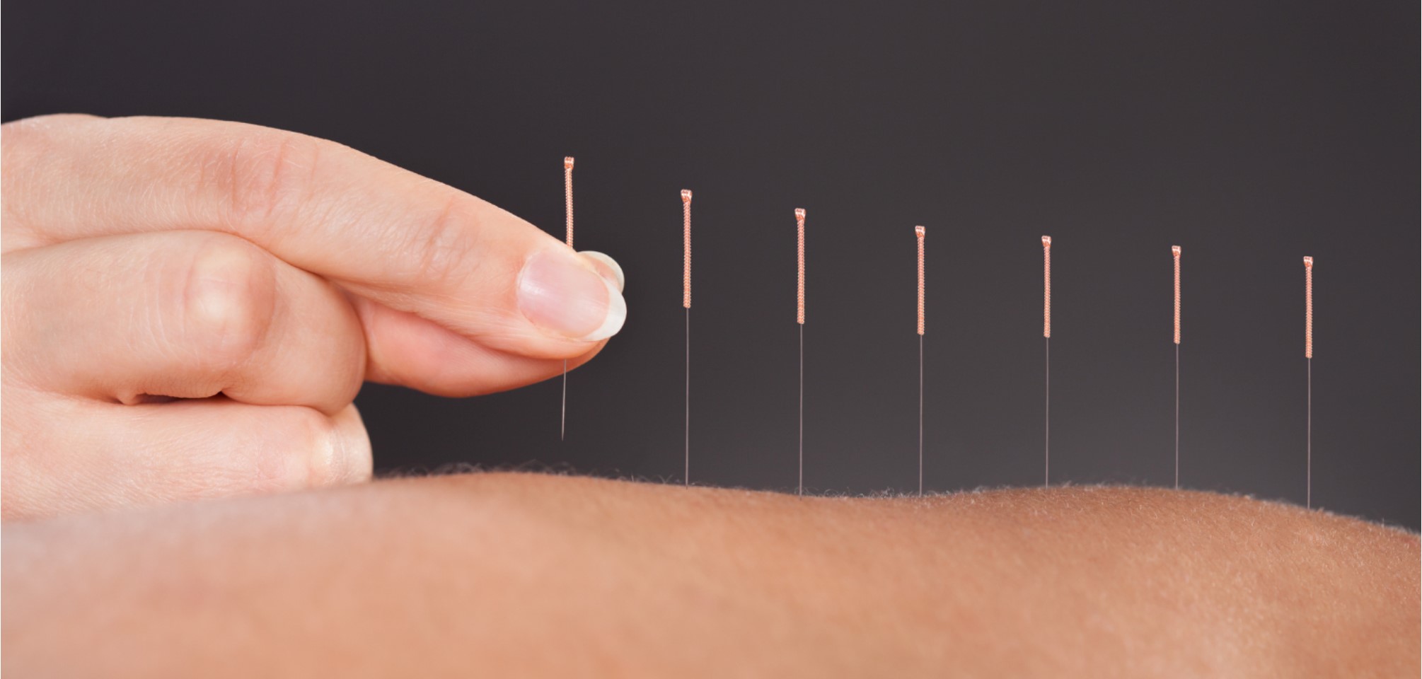 Get To The Point Basics And Benefits Of Acupuncture Goodwin House